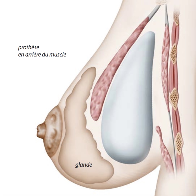 Docteur Poiret Blépharoplastie paupière inférieure