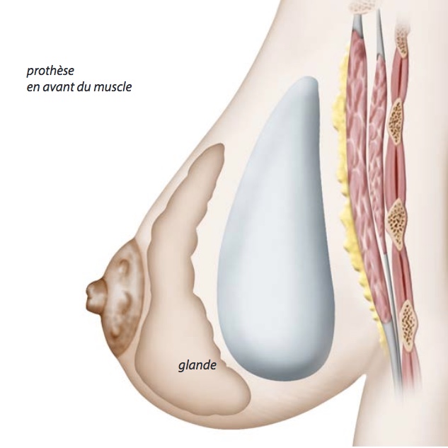 Docteur Poiret Blépharoplastie paupière supérieure