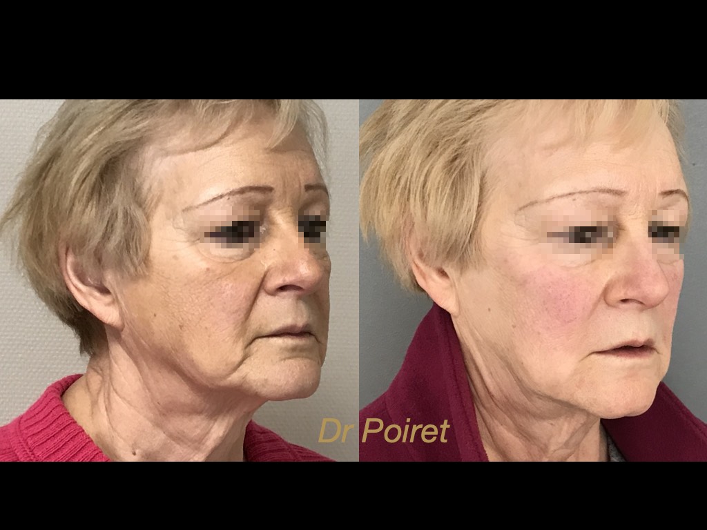 Docteur Poiret Blépharoplastie paupière inférieure