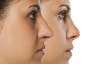 La rhinoplastie : évolution vers une préservation